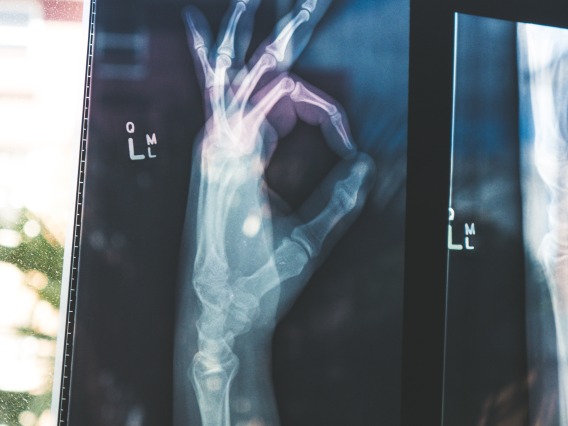 x-ray of a hand
